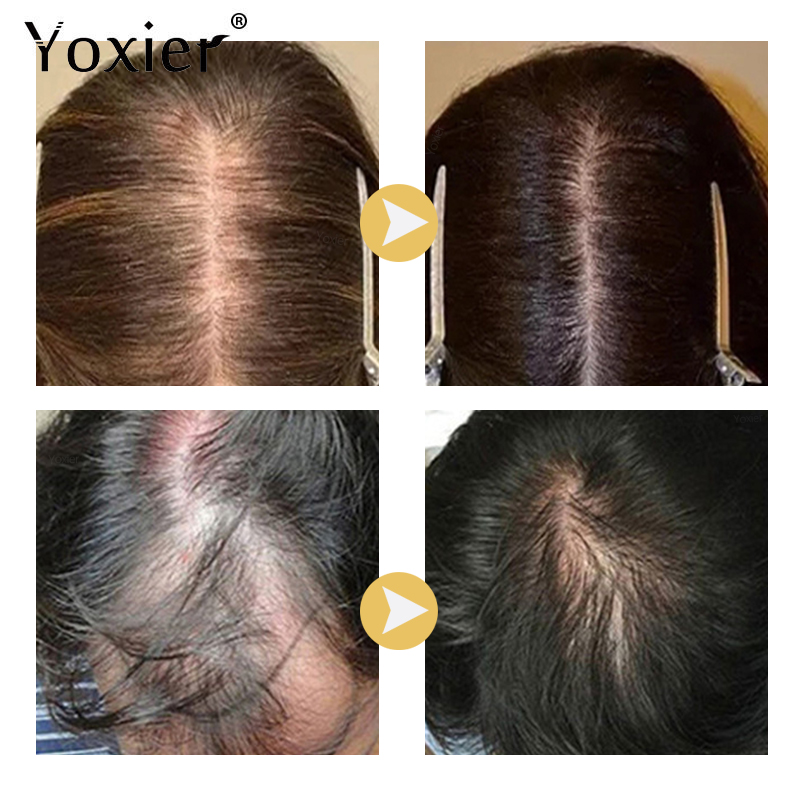 Intensive Growth Serum Prevent - Hair Care For Hair Loss review and price